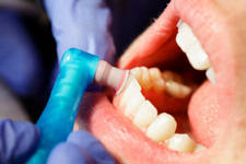 gingival cleaning