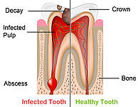 Root Canal Therapy1