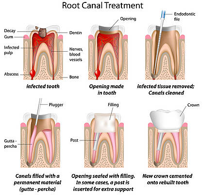 Root Canal Therapy2