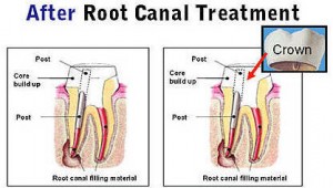 Root Canal Therapy (Nerve Treatment)