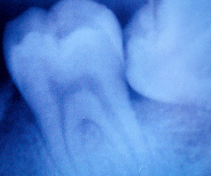 ROOT CANAL THERAPY