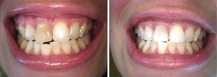 Zaki Dental-Root Canal- Before and After